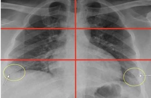 Radiologia na Medimagem Natal e sua importância contra o Covid-19